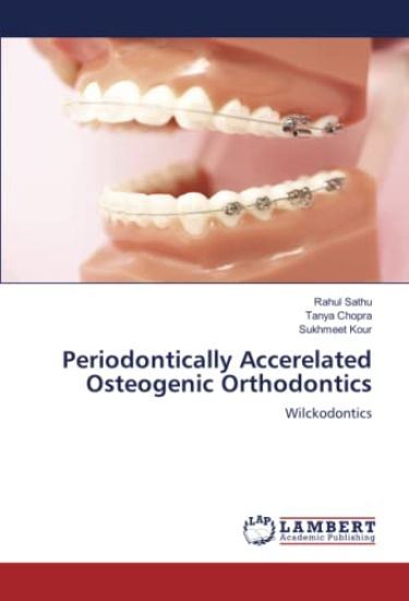 Periodontically Accerelated Osteogenic Orthodontics
