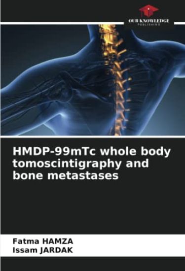 HMDP-99mTc whole body tomoscintigraphy and bone metastases