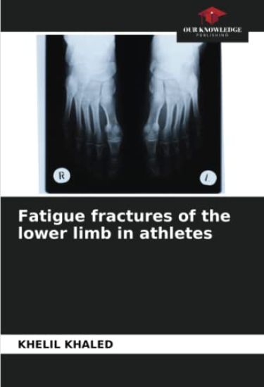 Fatigue fractures of the lower limb in athletes