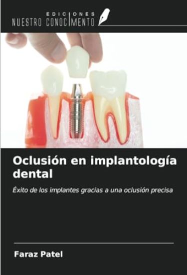 Oclusión en implantología dental
