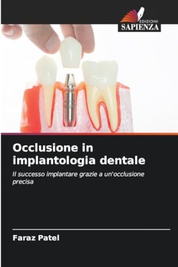 Occlusione in implantologia dentale