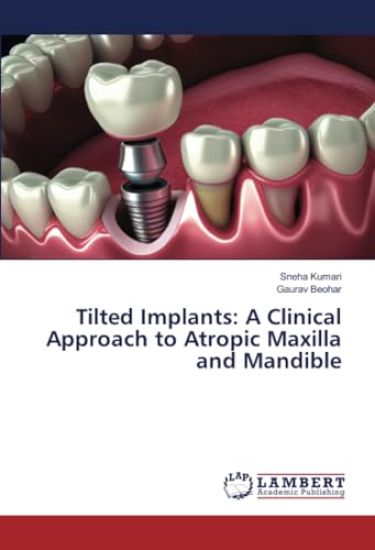Tilted Implants: A Clinical Approach to Atropic Maxilla and Mandible