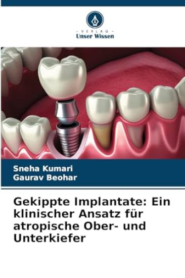 Gekippte Implantate