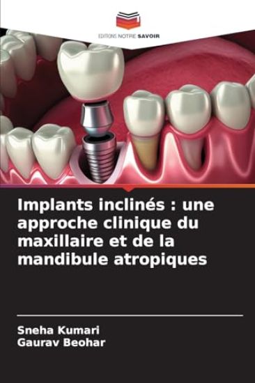 Implants inclinés