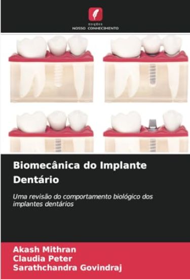 Biomecânica do Implante Dentário