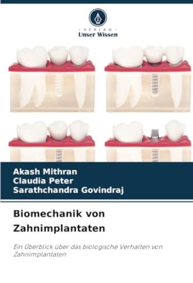 Biomechanik von Zahnimplantaten