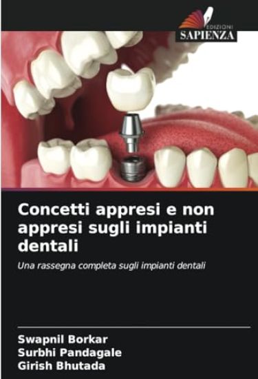 Concetti appresi e non appresi sugli impianti dentali