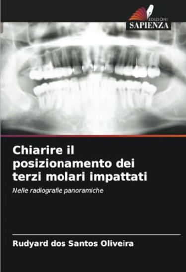 Chiarire il posizionamento dei terzi molari impattati