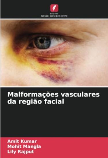 Malformações vasculares da região facial