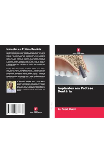 Implantes em Prótese Dentária