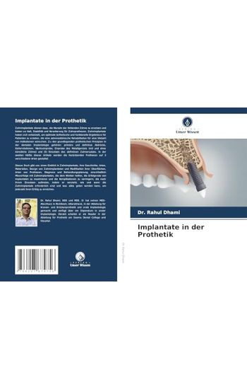 Implantate in der Prothetik