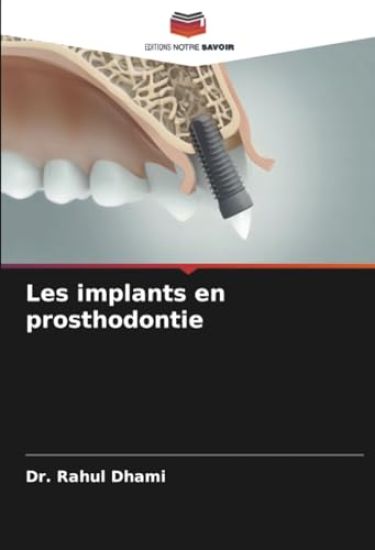 Les implants en prosthodontie