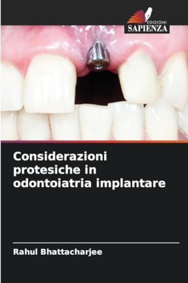 Considerazioni protesiche in odontoiatria implantare