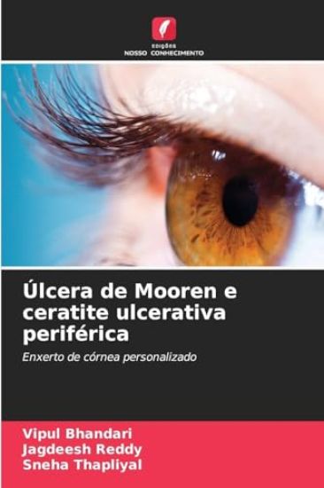 Úlcera de Mooren e ceratite ulcerativa periférica