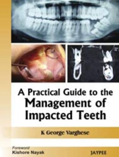 A Practical Guide to the Management of Impacted Teeth