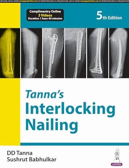 Tanna’s Interlocking Nailing
